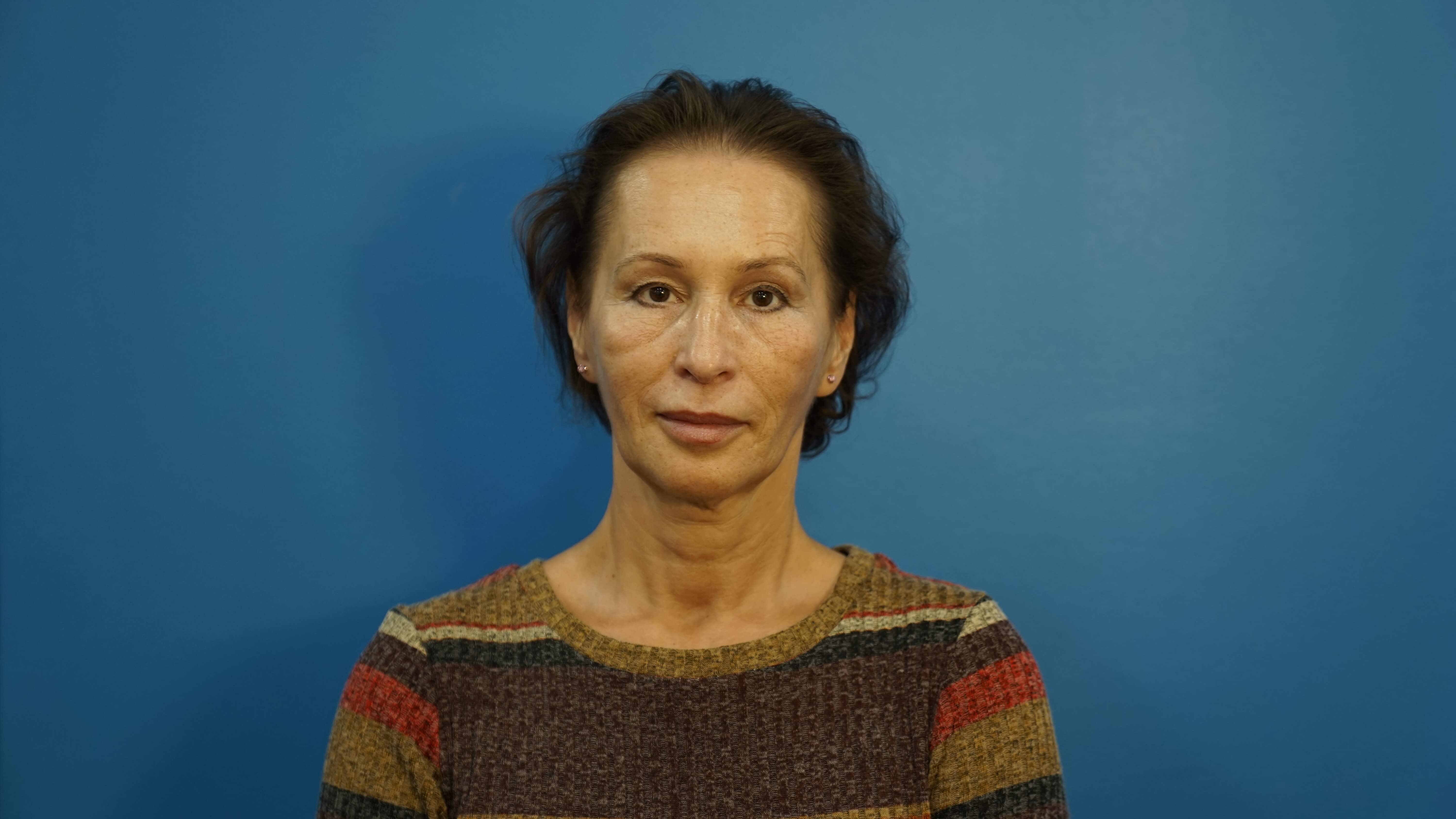 Woman has Neck Lift, Fat Graft Before