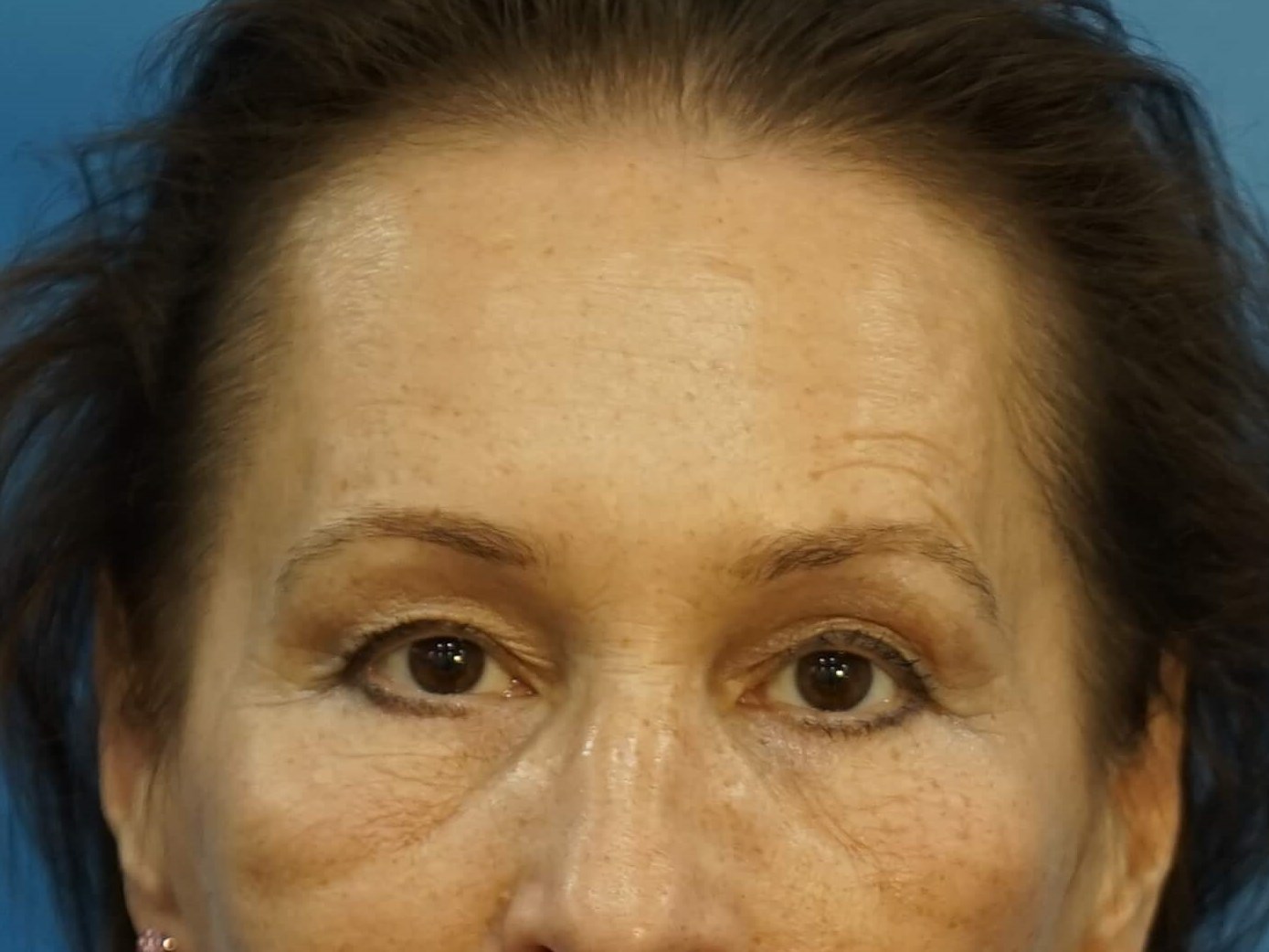 Woman has Neck Lift, Fat Graft Before