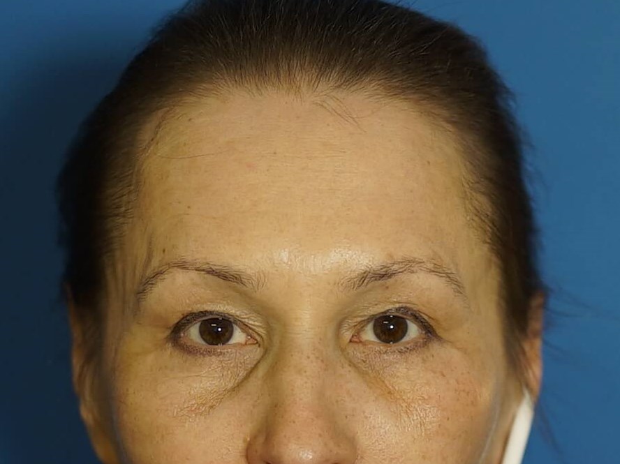 Woman has Neck Lift, Fat Graft After