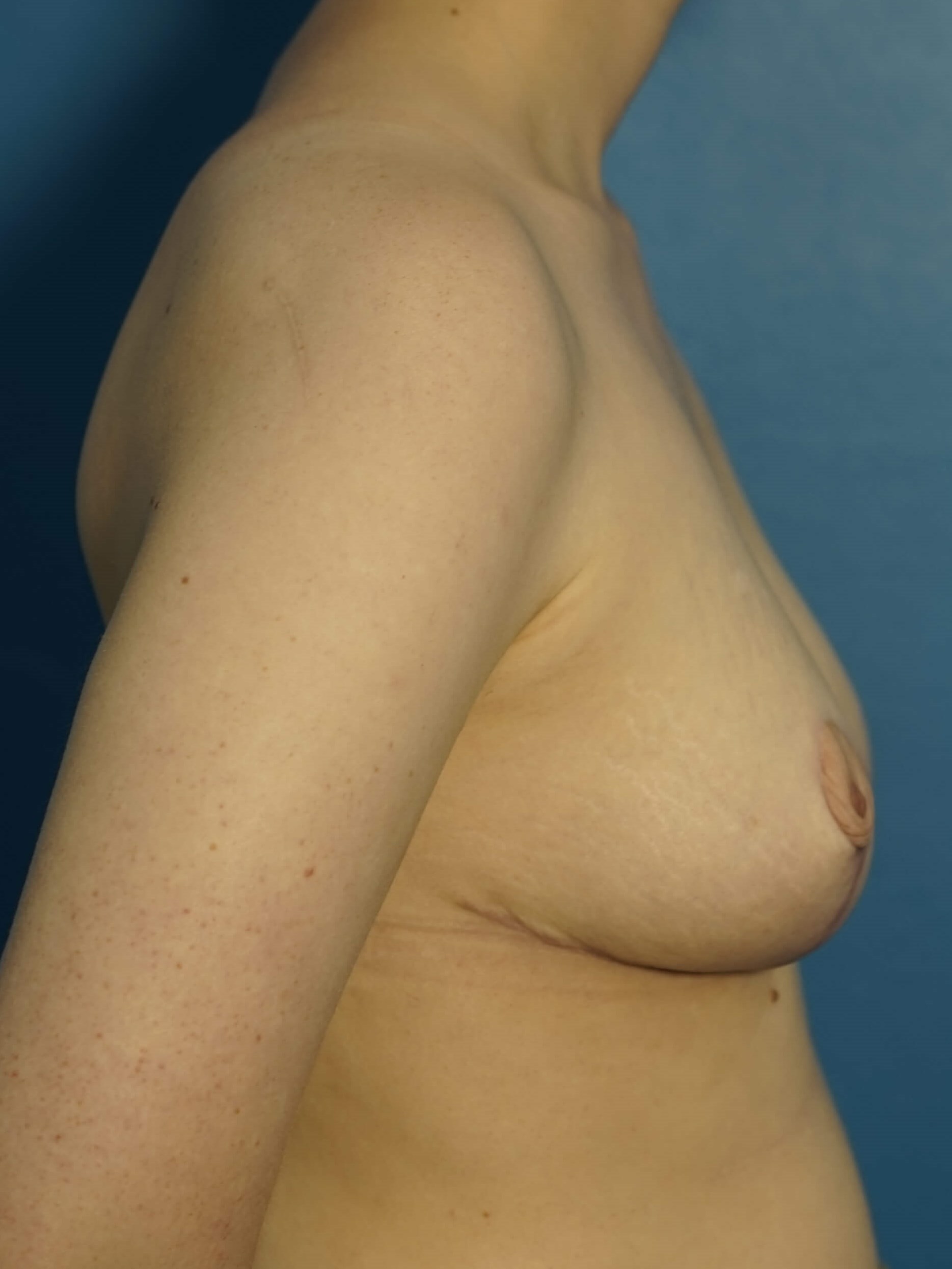 Westlake Woman has Breast Lift After