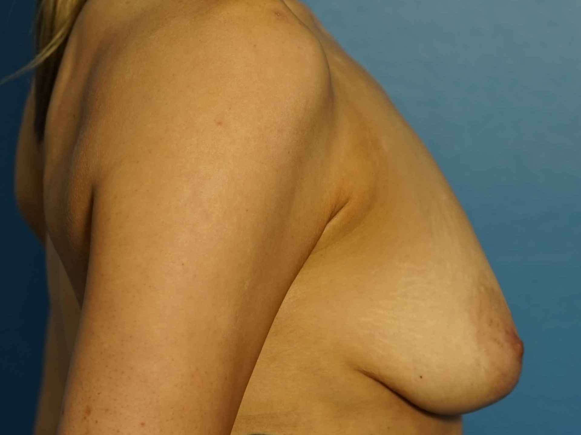 Westlake Woman Has Breast Aug Before