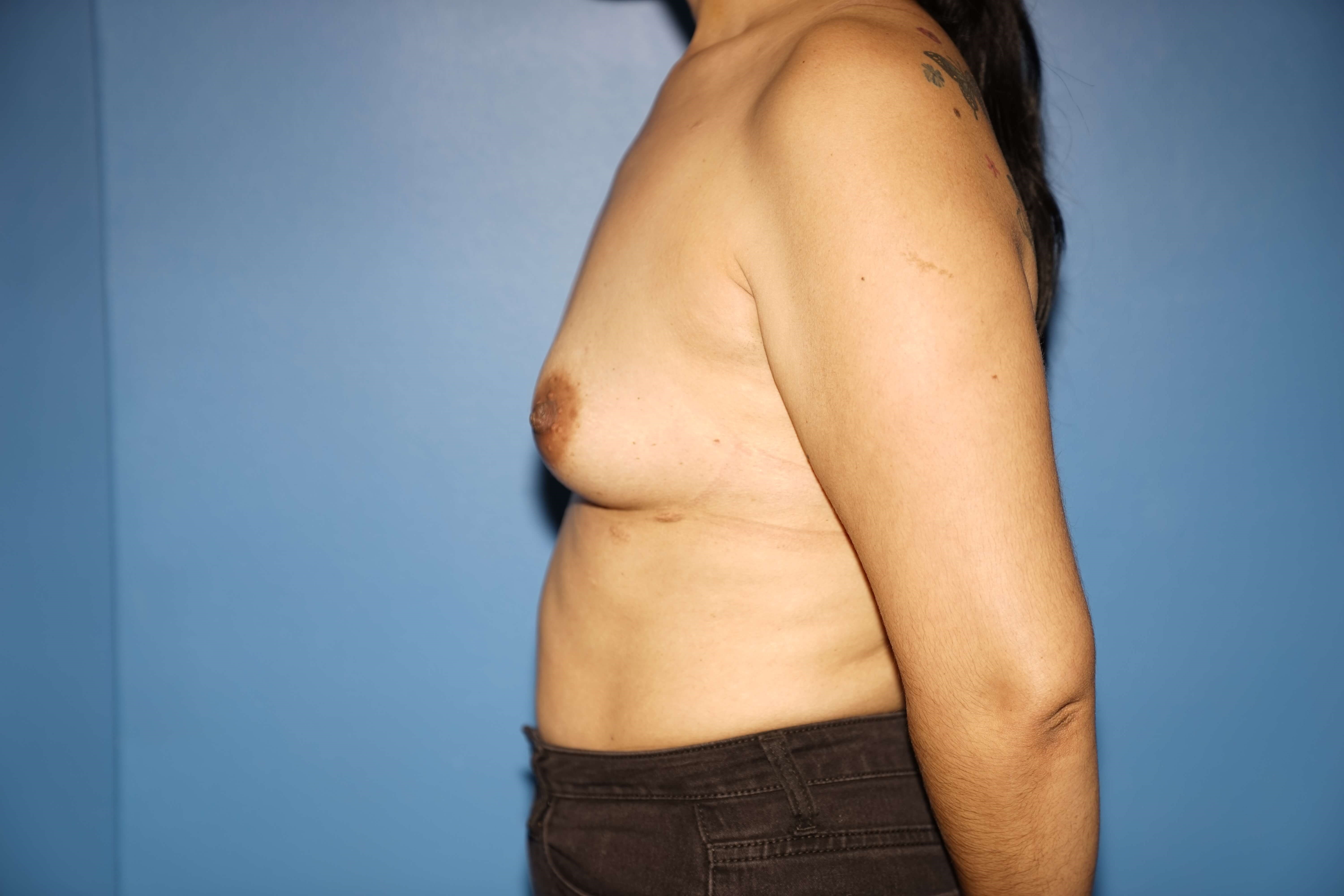 Westlake Woman Has Breast Aug Before