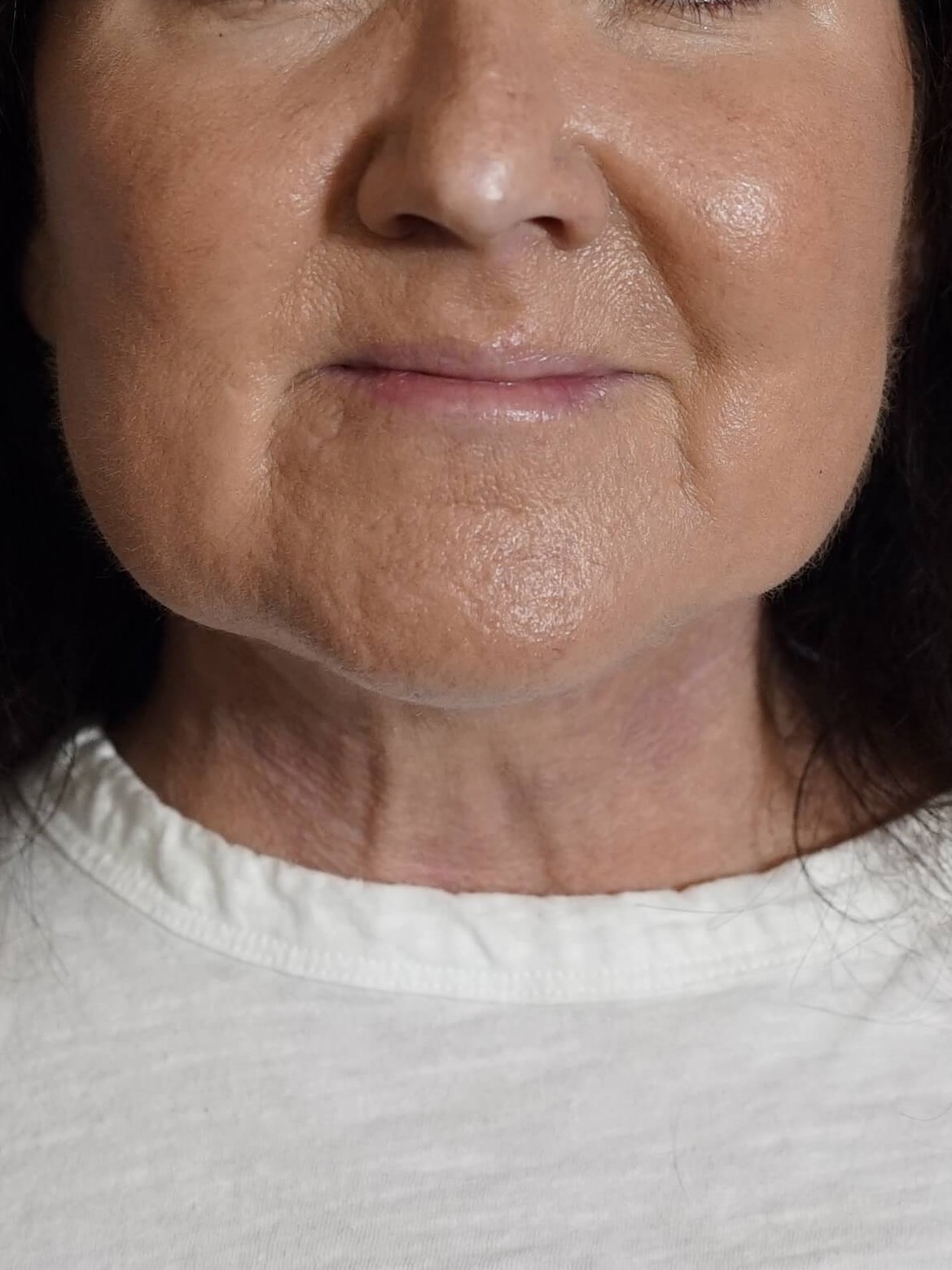 Woman has Neck Lift After