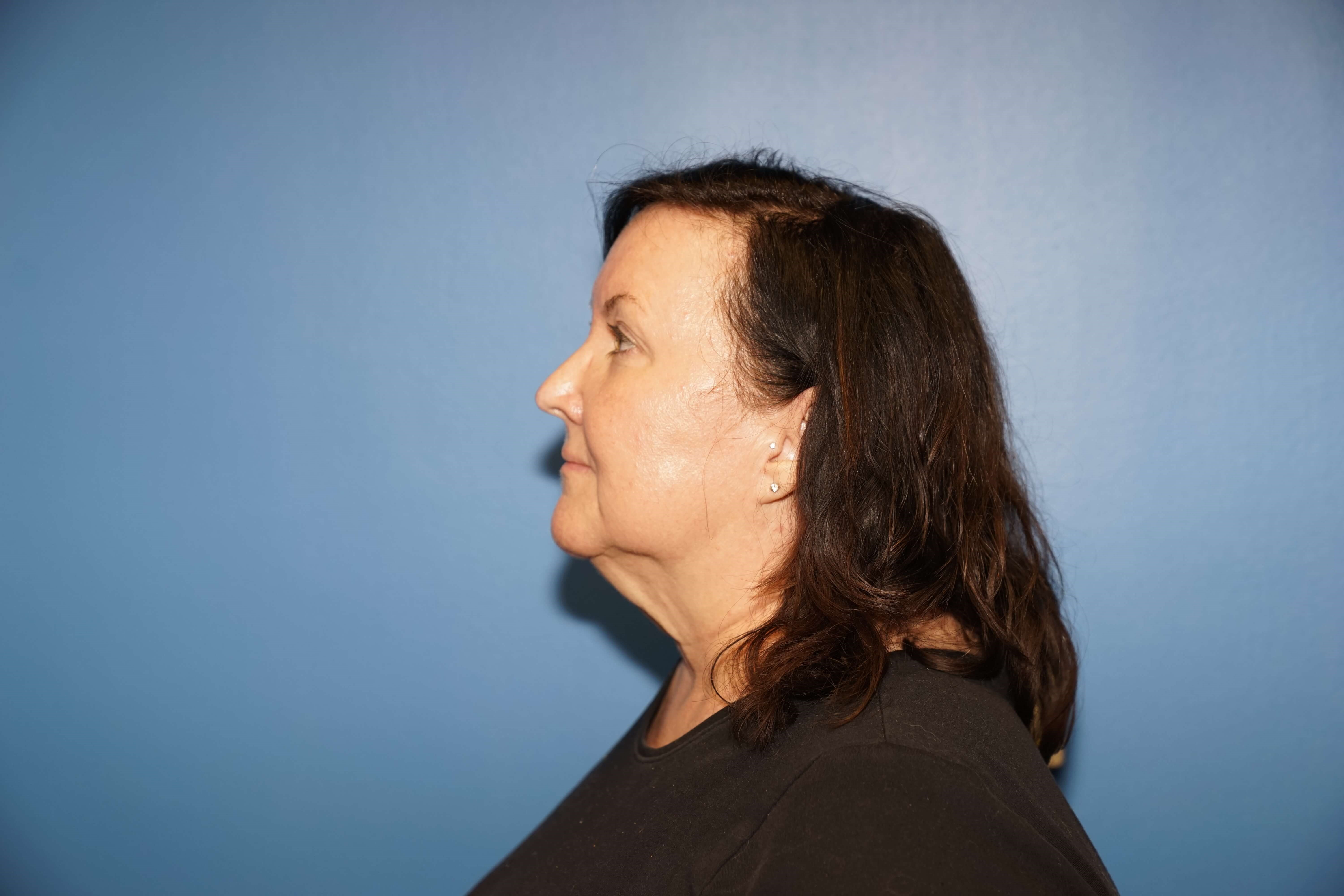 Woman has Neck Lift Before