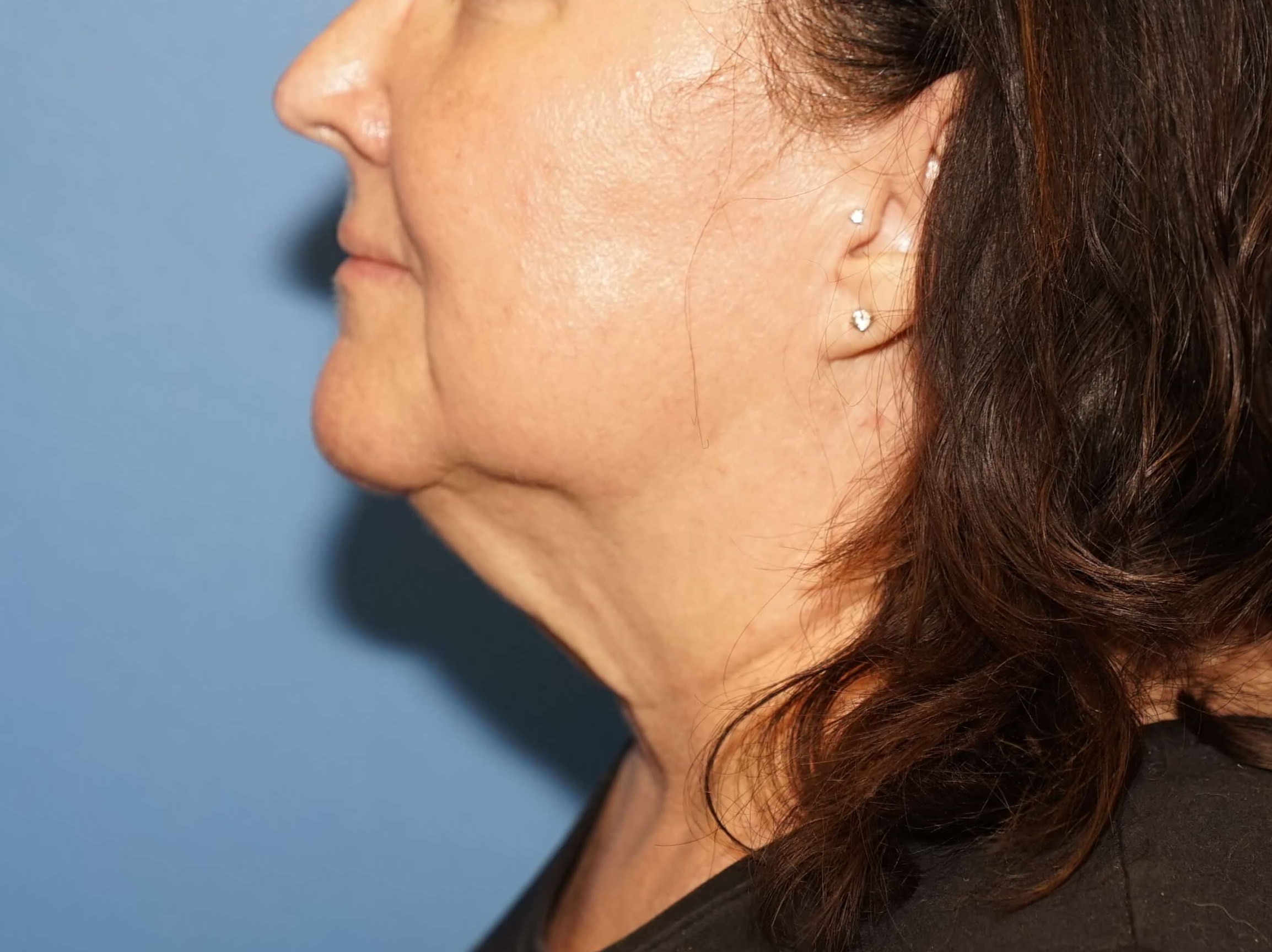 Woman has Neck Lift Before
