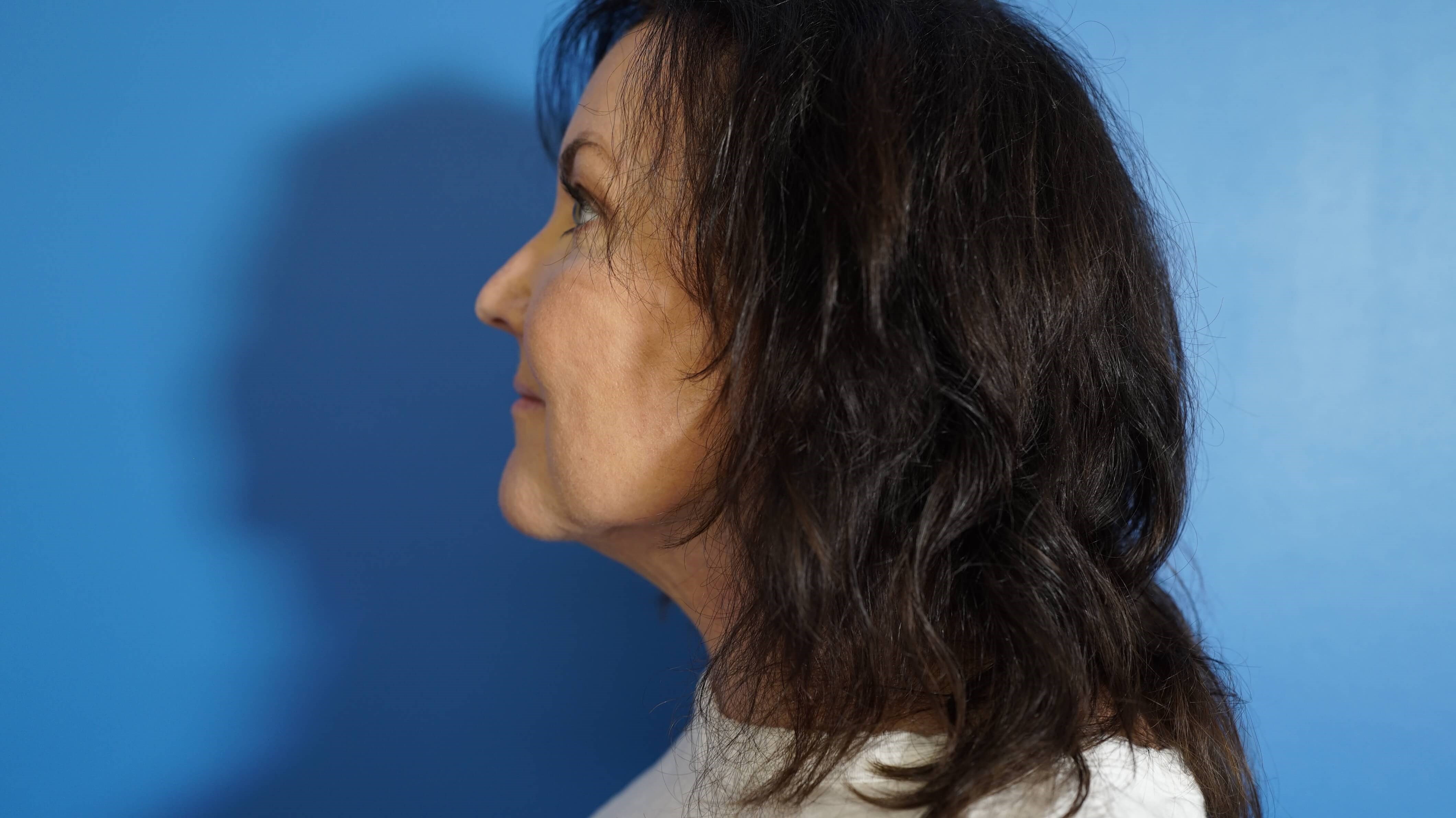 Woman has Neck Lift After