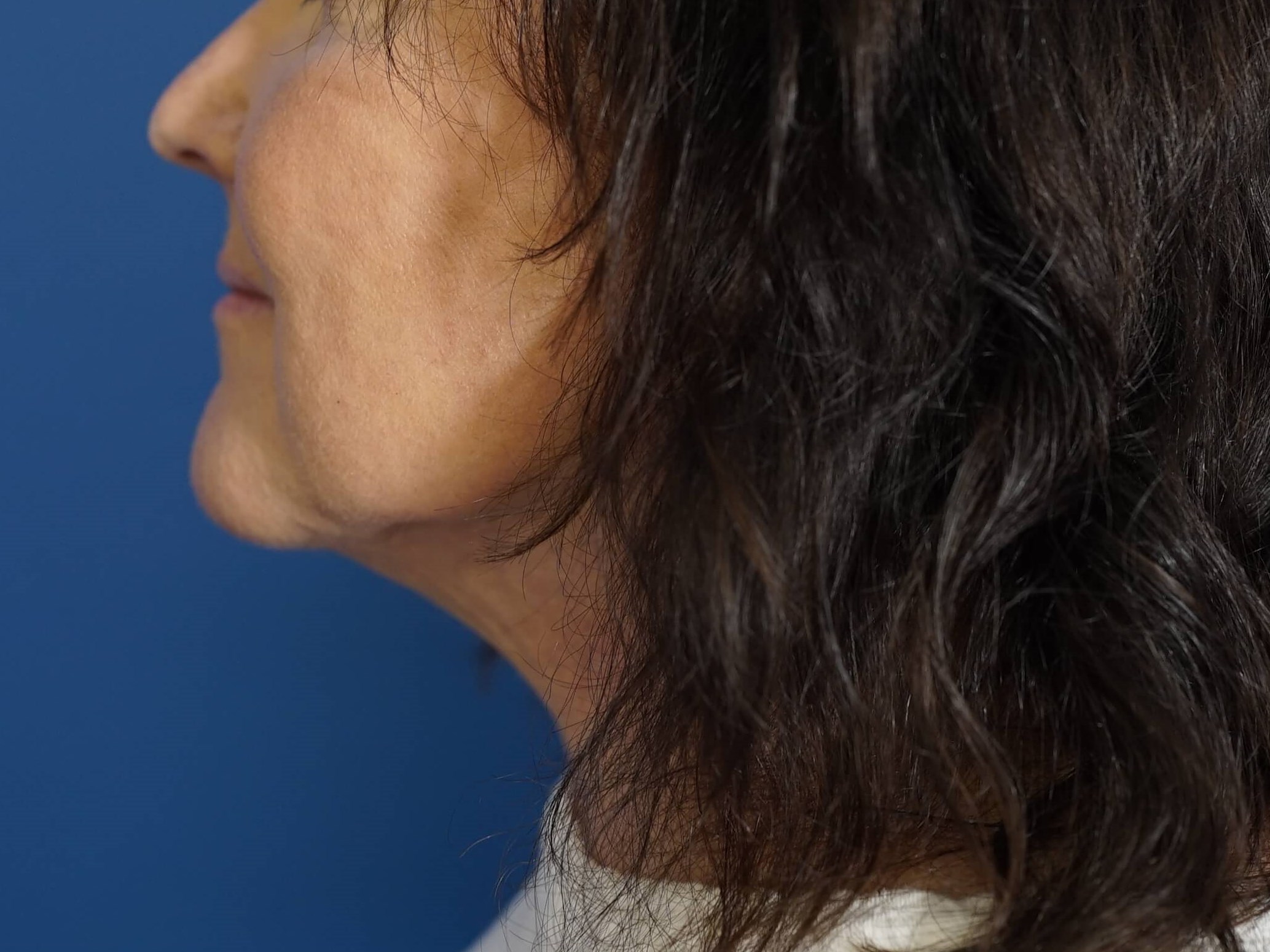 Woman has Neck Lift After